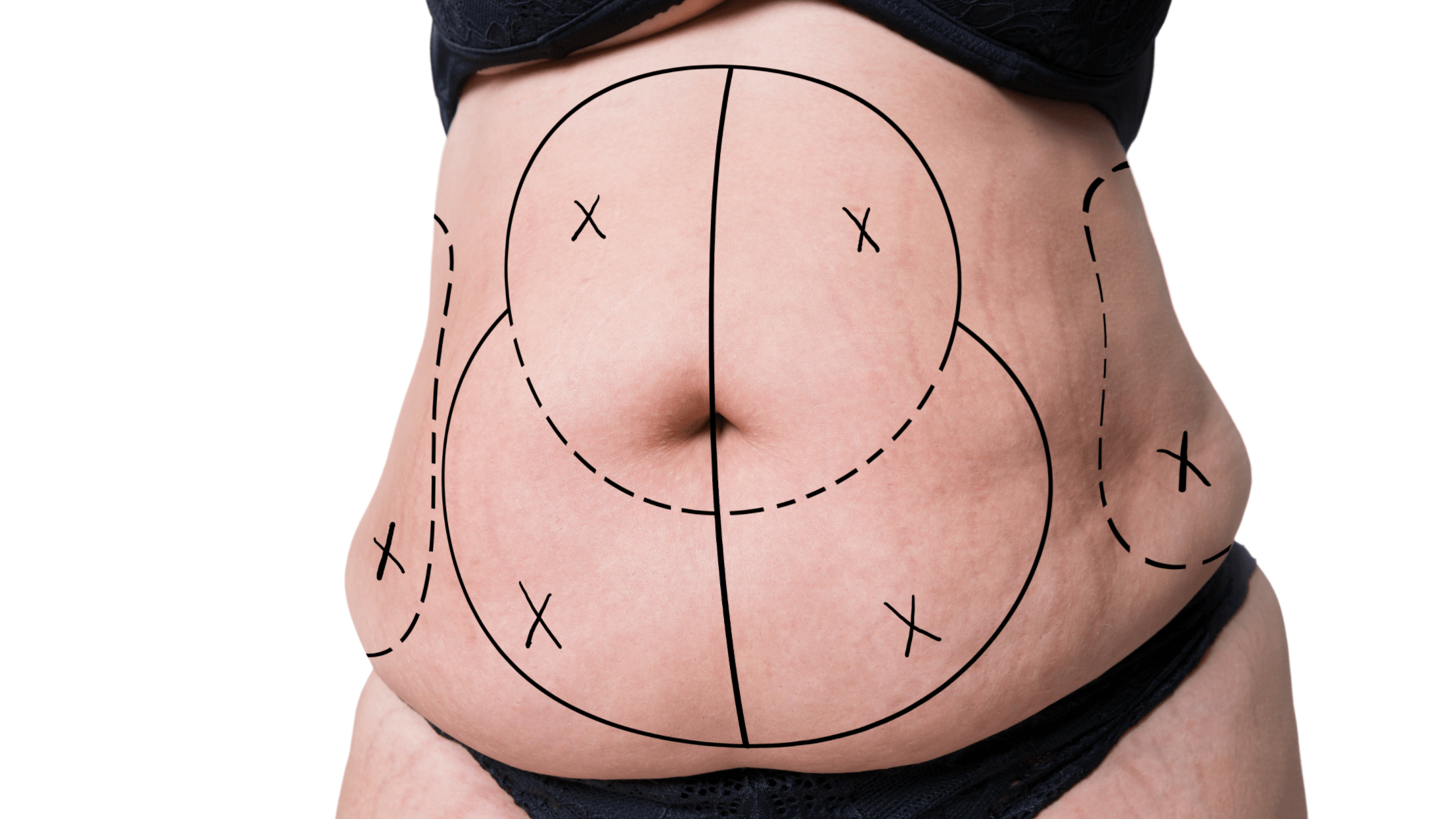 Who Is a Candidate For a Drainless Tummy Tuck?